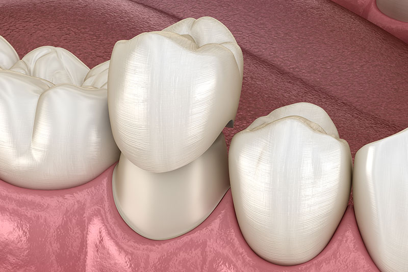 Dental Crowns and Bridges in Jupiter