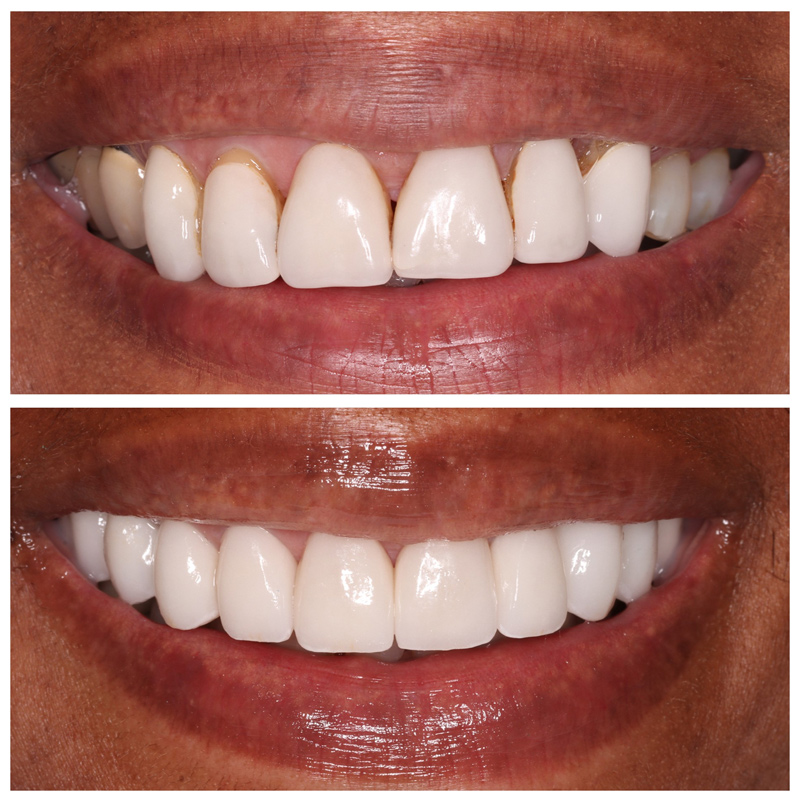 Cosmetic Veneers Jupiter Fl