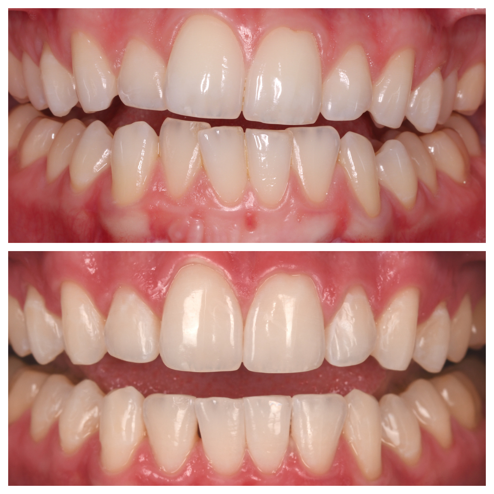 Invisalign Jupiter Fl