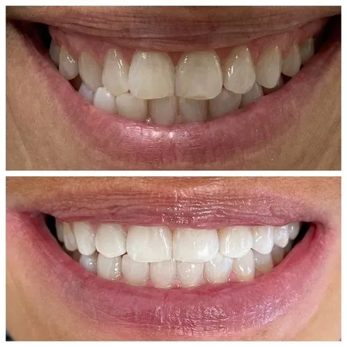 Invisalign in Jupiter