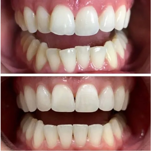 Invisalign in Jupiter