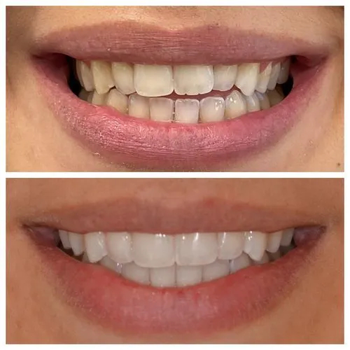 Invisalign Gallery Before After Photos in Jupiter 