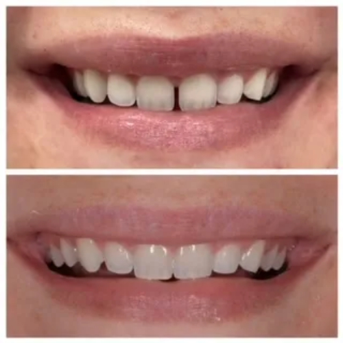Invisalign Before After Photos in in Jupiter 