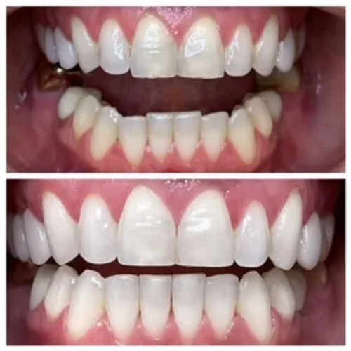 Invisalign Before After Photos in Jupiter 