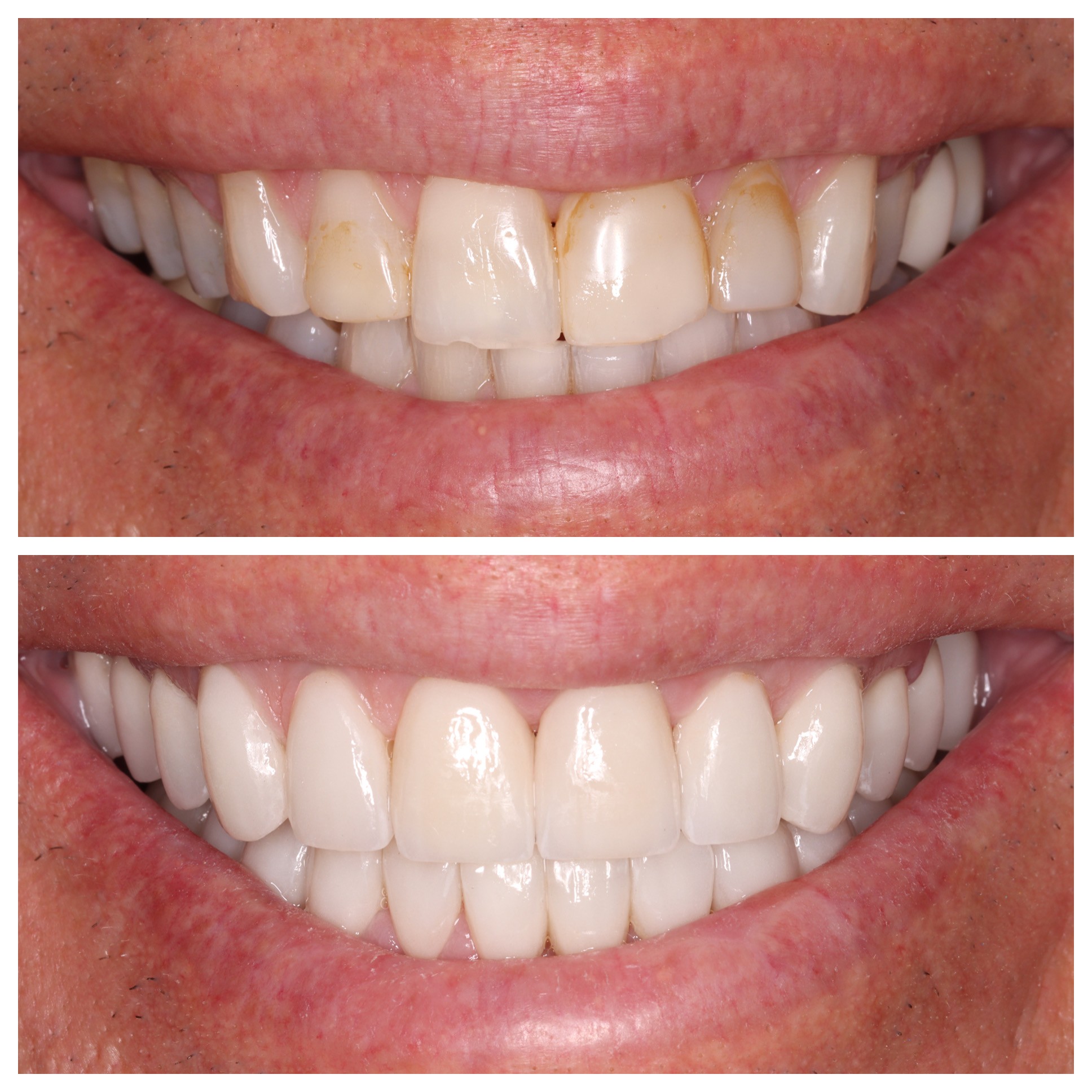 Cosmetic Veneers Jupiter Fl