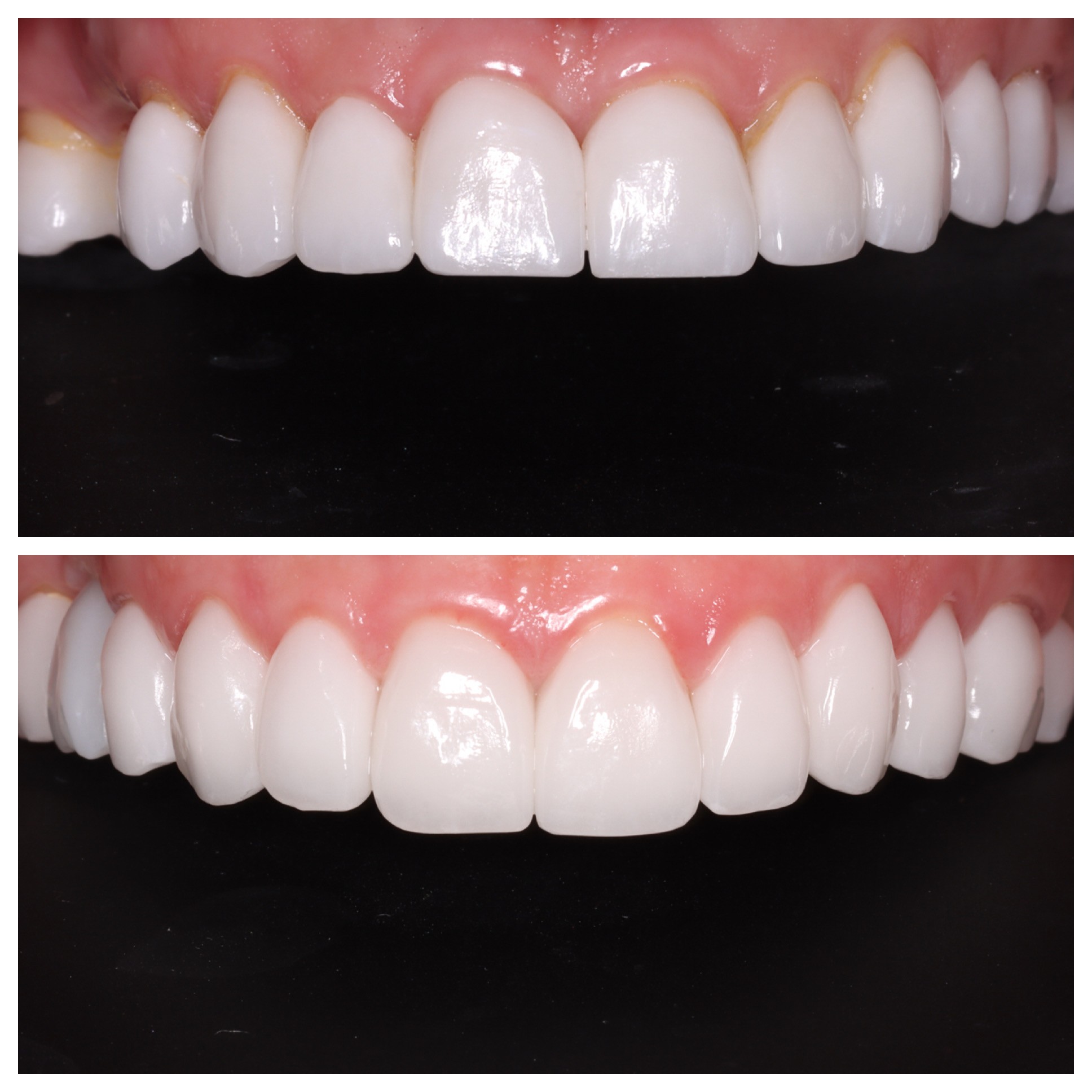 Cosmetic Veneers Jupiter Fl