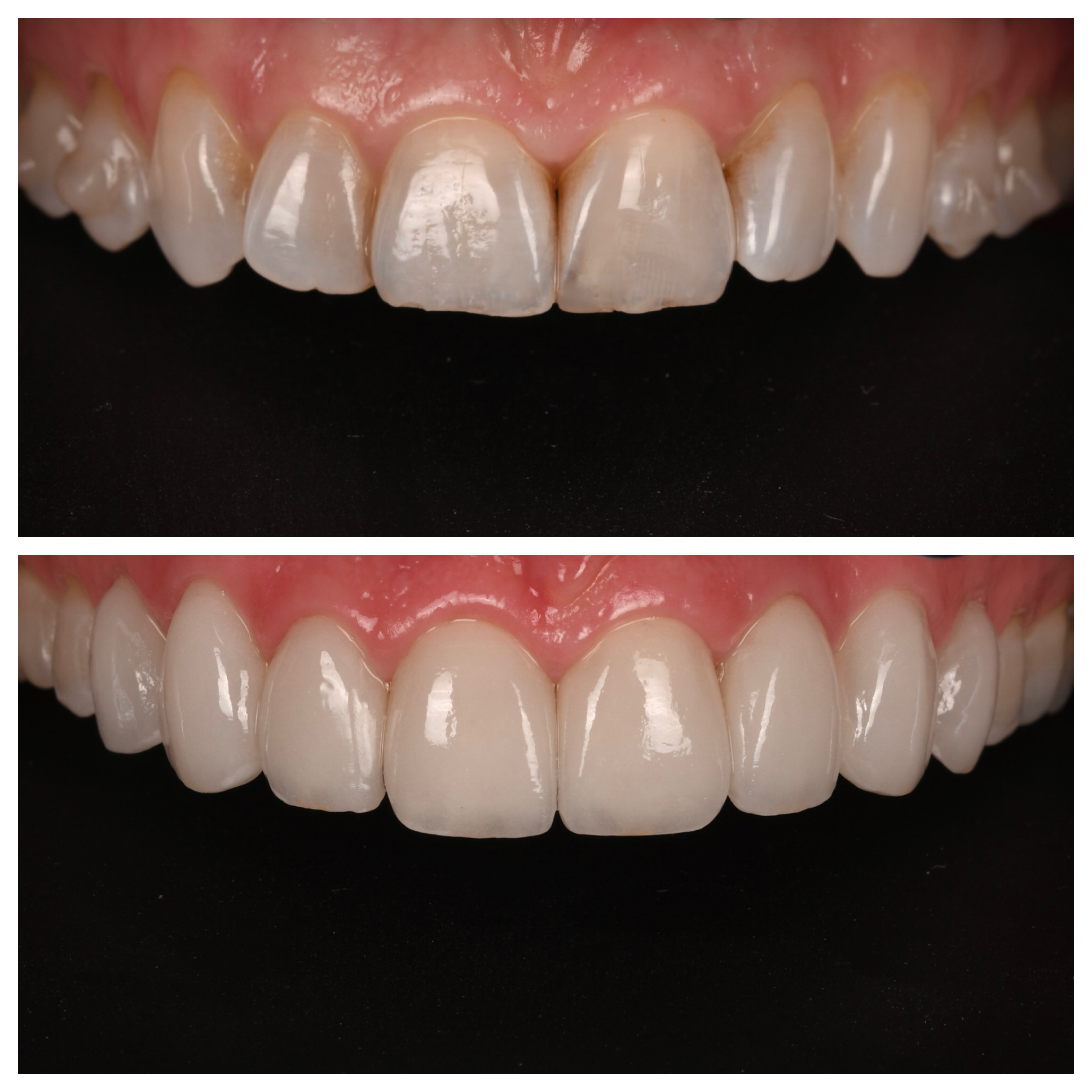 Veneers Jupiter Fl