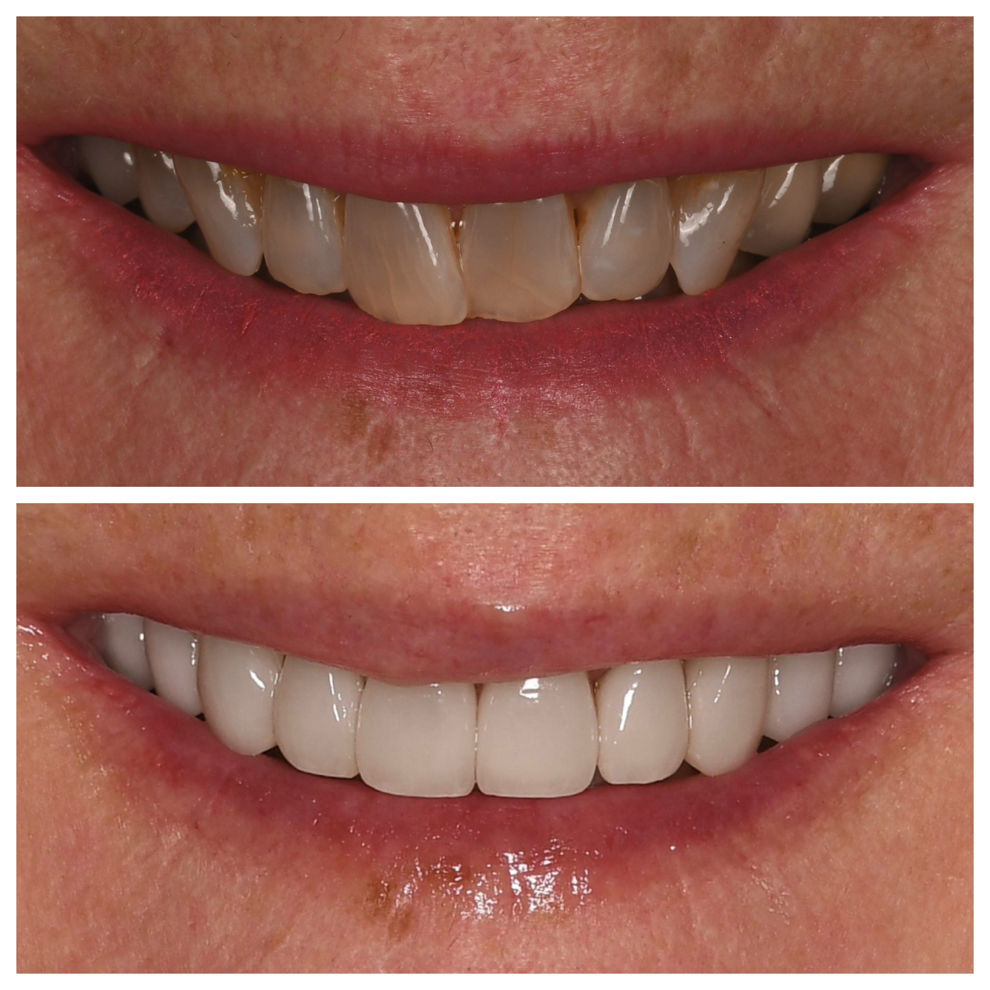 Veneers Jupiter Fl