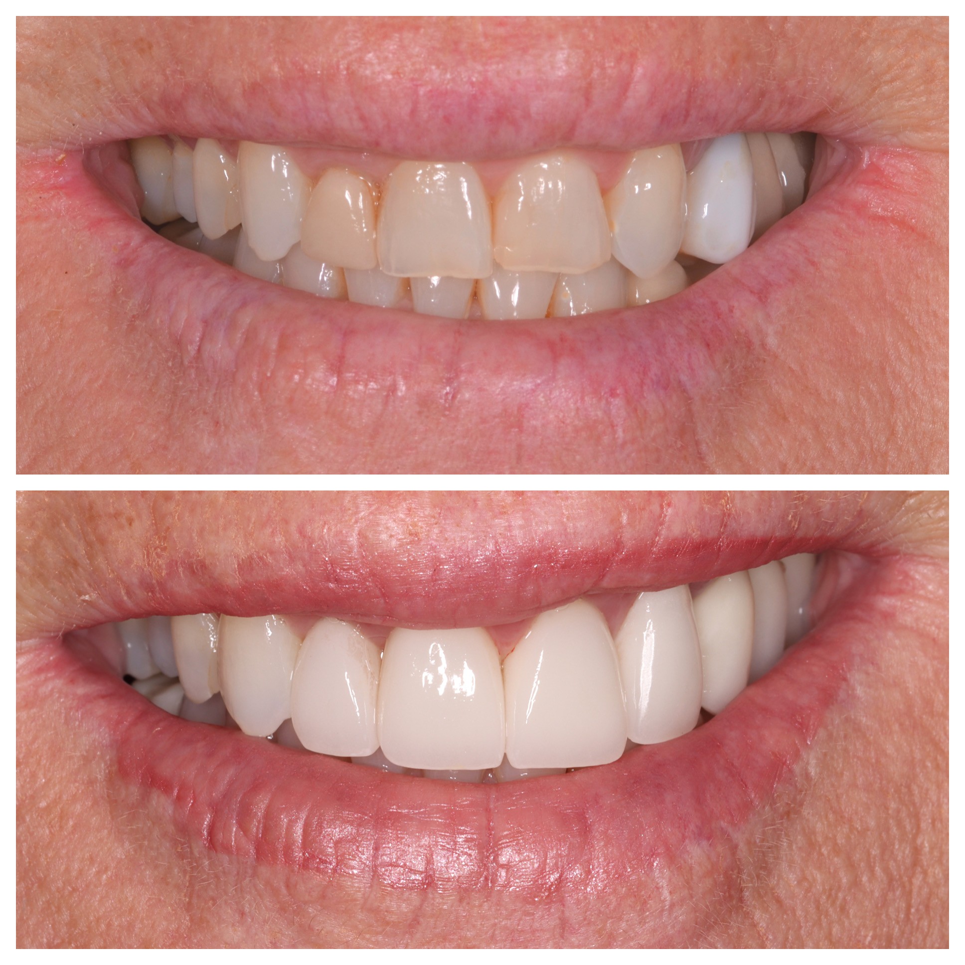 Cosmetic Veneers Jupiter Fl