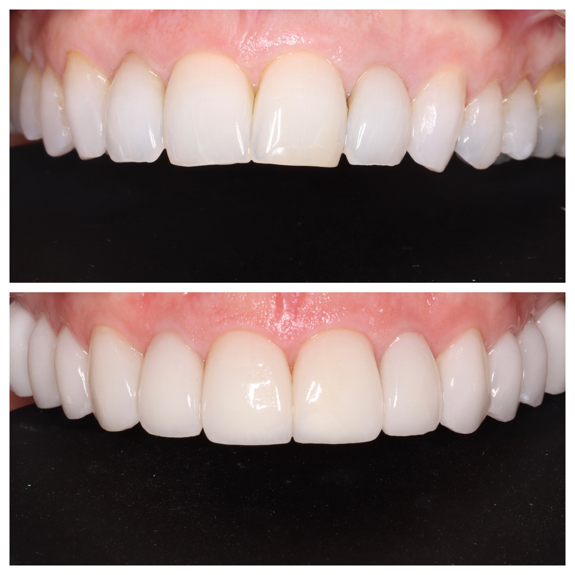 Cosmetic Veneers Jupiter Fl