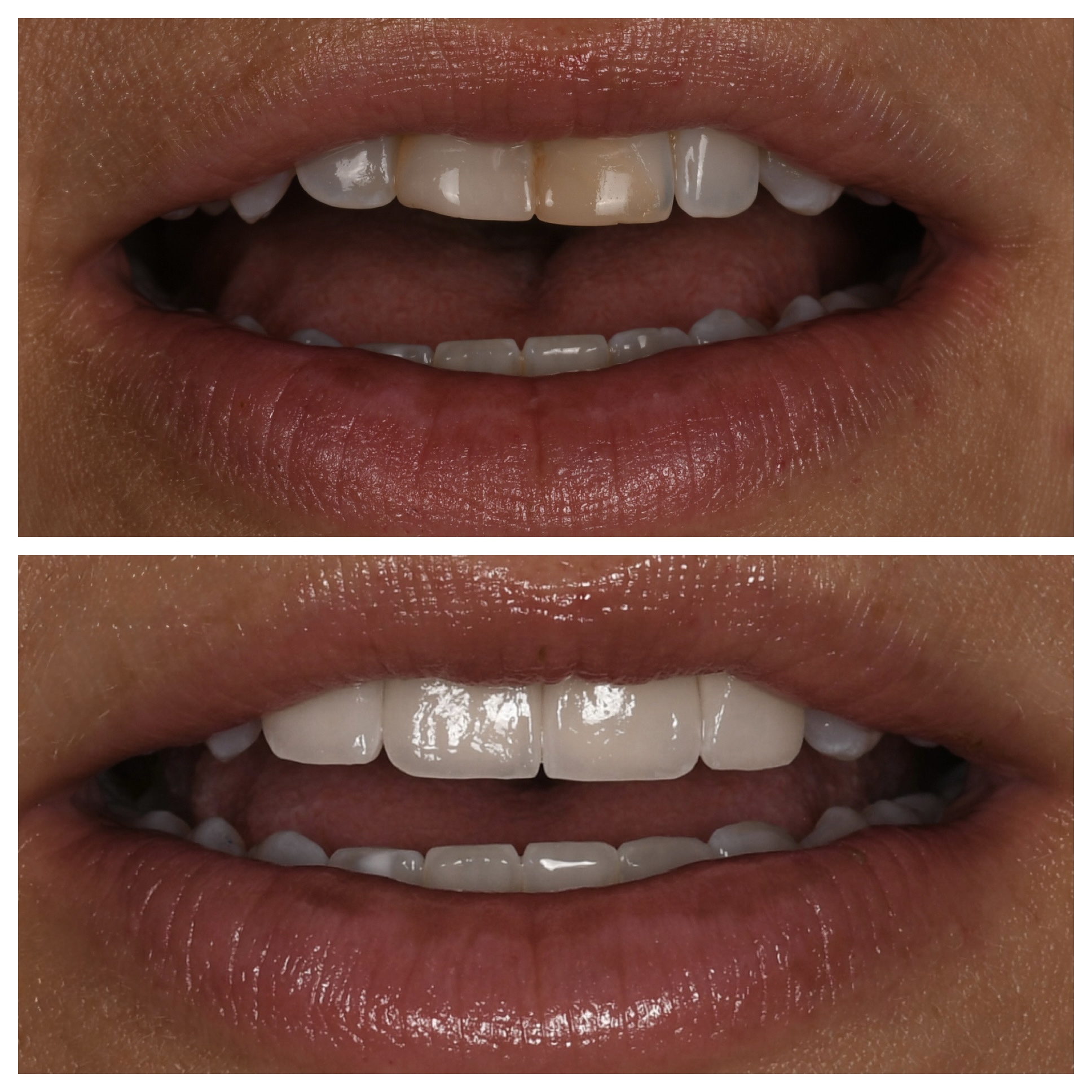Veneers Jupiter Fl
