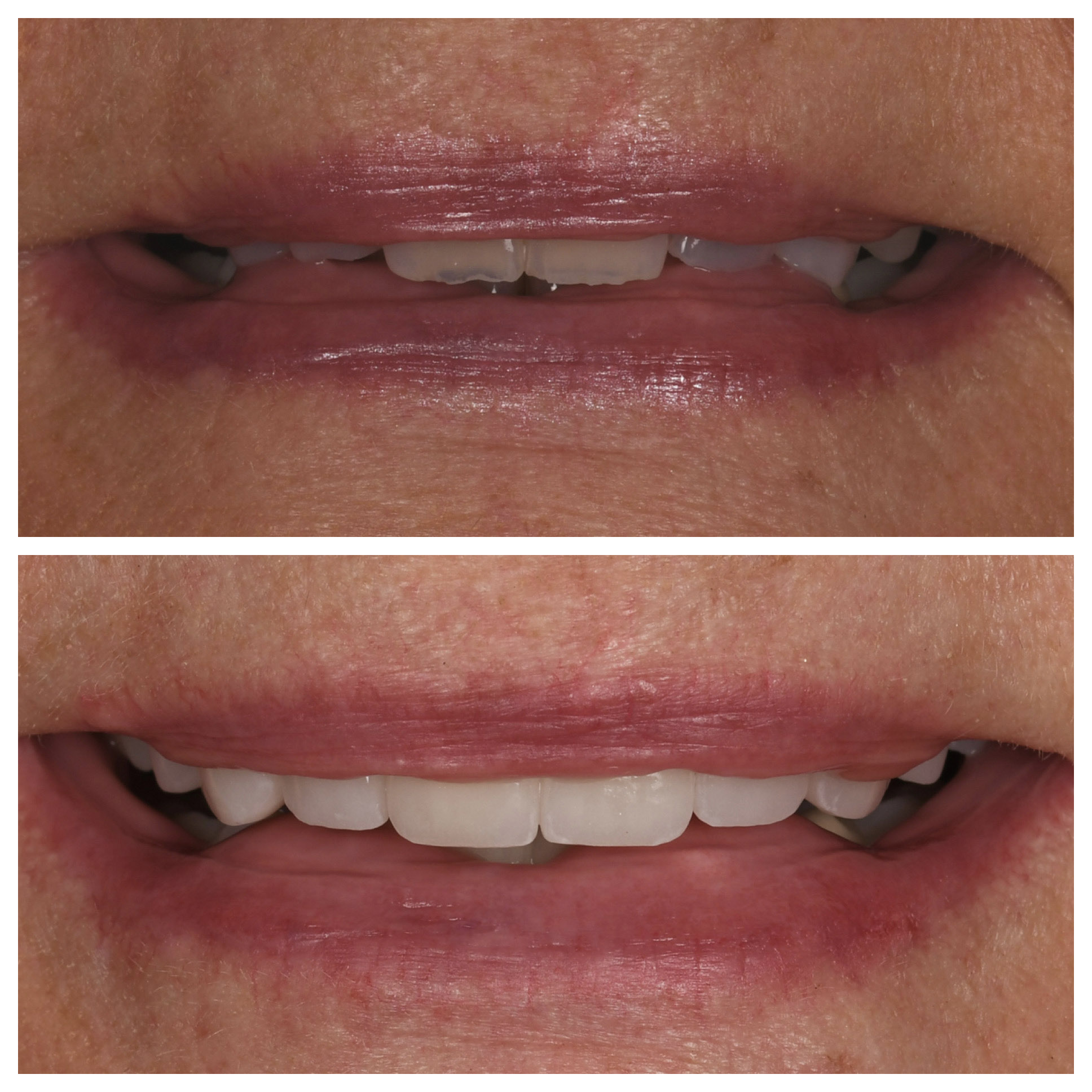 Veneers Jupiter Fl