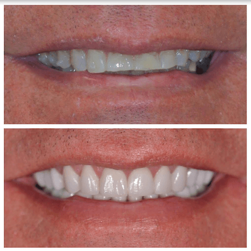 Dental Veneers in Jupiter