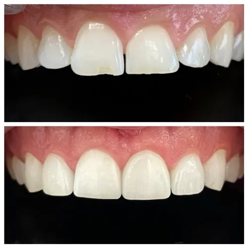 Dental Veneers Gallery Before After Photos in Jupiter 