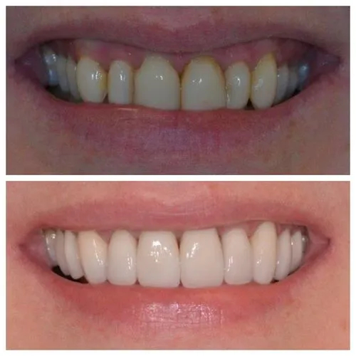 Dental Veneers Before After Photos in in Jupiter 