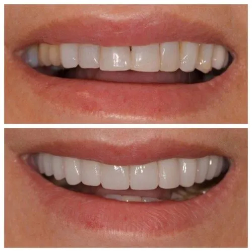 Dental Veneers Before After Photos in Jupiter 