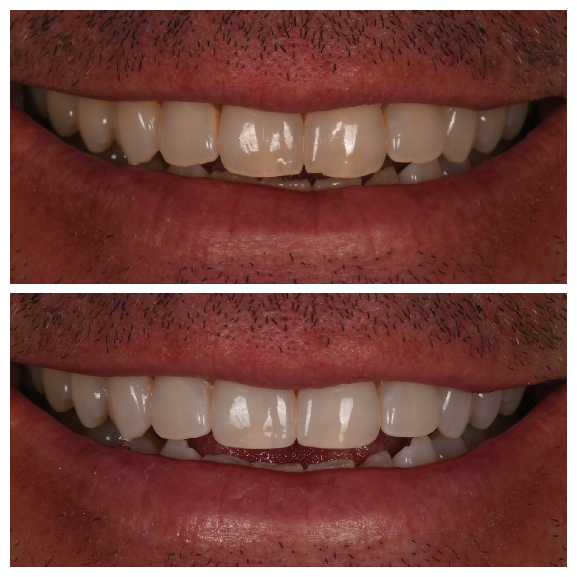 Whitening Jupiter Fl