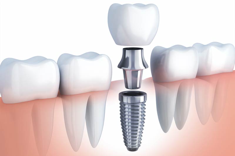 Implant Dentistry in Jupiter