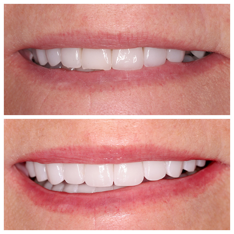 Cosmetic Veneers Jupiter Fl