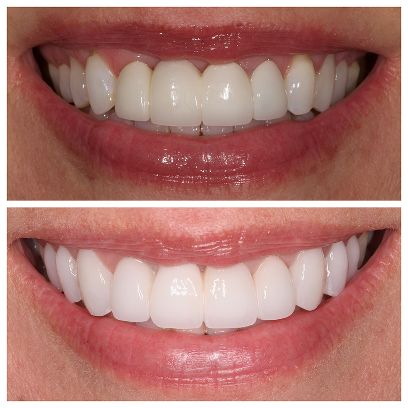 Cosmetic Veneers Jupiter Fl