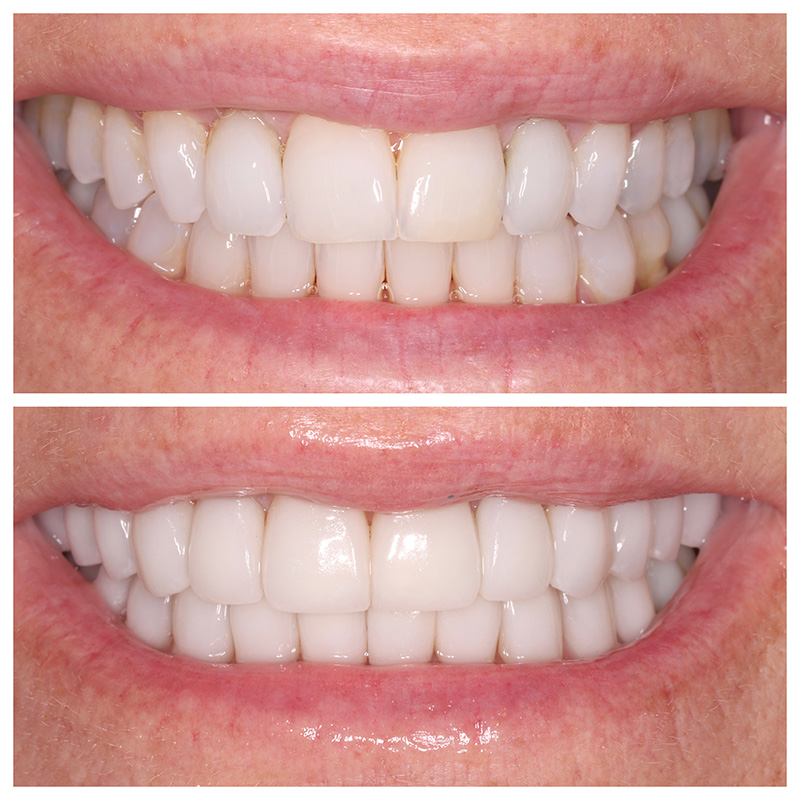 Cosmetic Veneers Jupiter Fl