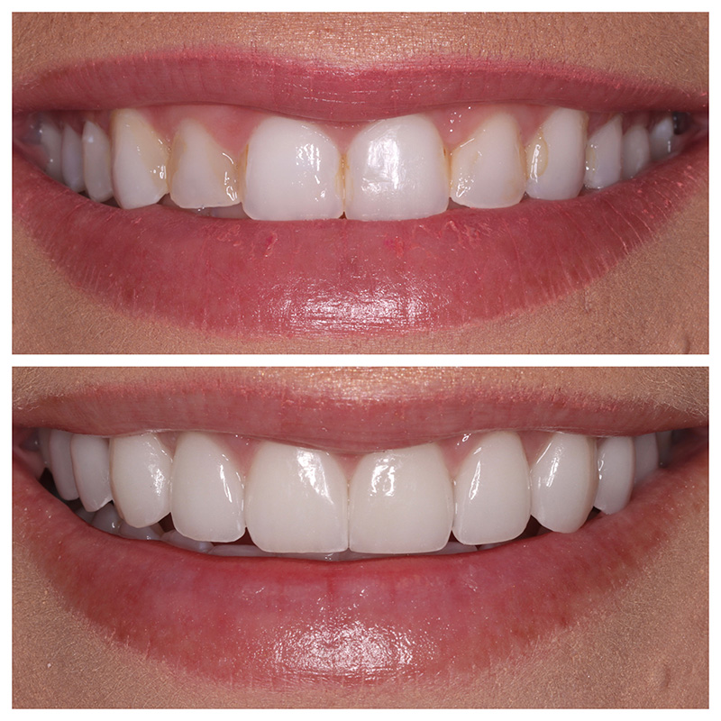 Cosmetic Veneers Jupiter Fl