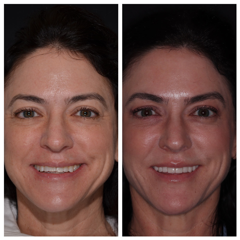 Cosmetic Veneers Jupiter Fl