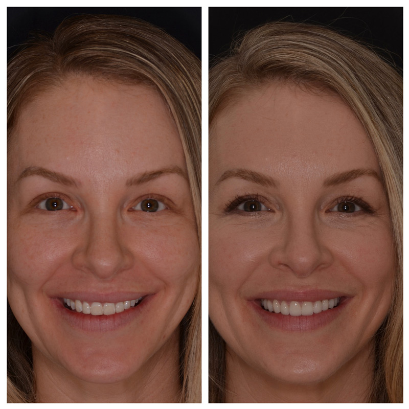 Cosmetic Veneers Jupiter Fl