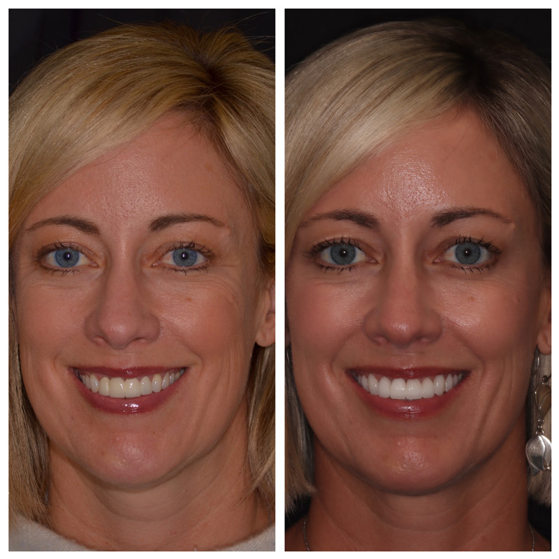 Cosmetic Veneers Jupiter Fl